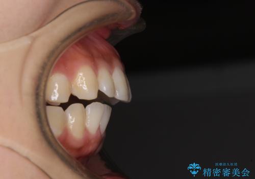 前に出ている上顎 抜歯矯正で唇を閉じやすくの治療前