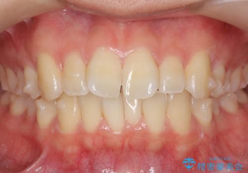 インビザライン モニター治療 前歯のねじれをまっすぐに の治療中