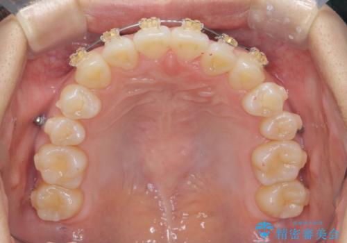 正中のズレ、引っ込んだ前歯の矯正の治療中