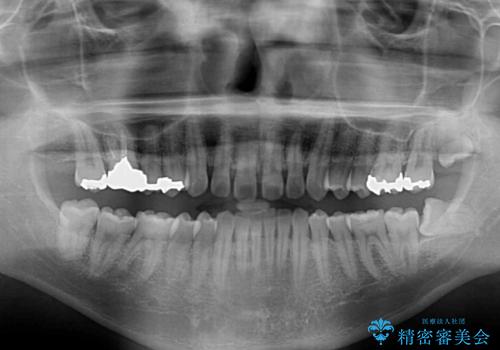 深い咬み合わせと前歯の隙間 ハーフリンガルによる矯正治療の治療前