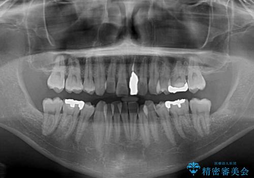 抜歯矯正で八重歯を改善 インビザライン矯正治療の治療前