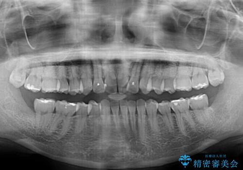 捻れた前歯をインビザラインで整えるの治療前
