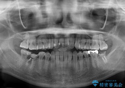 【モニター】開咬を治したい インビザラインによる矯正治療の治療前