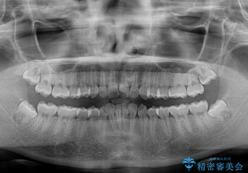 前歯のデコボコを治したい インビザライン・モデレートによる矯正治療の治療前