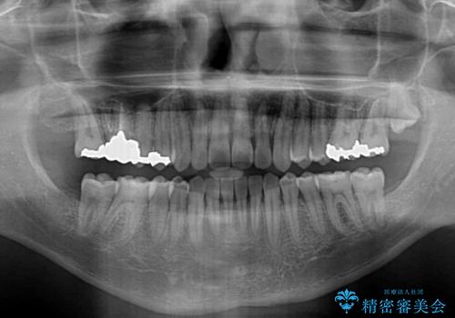 深い咬み合わせと前歯の隙間 ハーフリンガルによる矯正治療の治療後