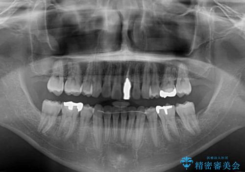 抜歯矯正で八重歯を改善　インビザライン矯正治療の治療後