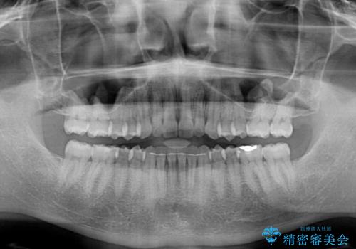 前歯のデコボコとクロスバイト インビザライン矯正治療の治療後