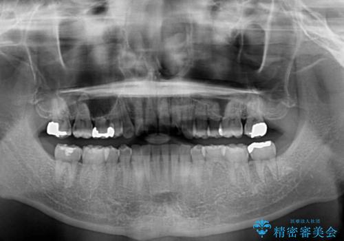 【モニター】前歯に隙間ができるほどのディープバイト ワイヤー装置で負担の少ない咬み合わせにの治療後