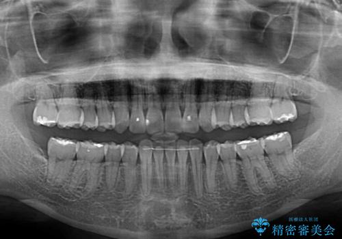 捻れた前歯をインビザラインで整えるの治療後