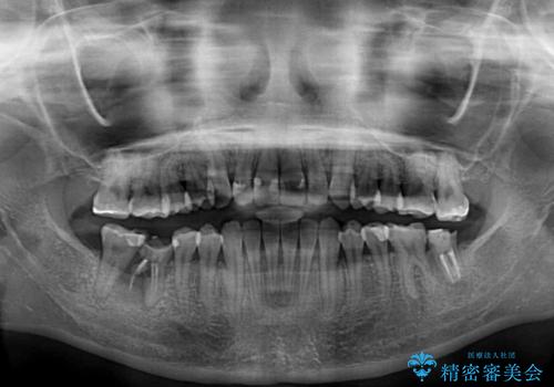 【モニター】開咬を治したい インビザラインによる矯正治療の治療後