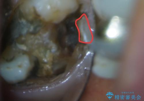 【セラミッククラウン】詰め物と歯の境目に穴が空いているの治療後