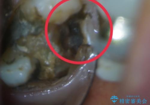 【セラミッククラウン】詰め物と歯の境目に穴が空いているの治療中