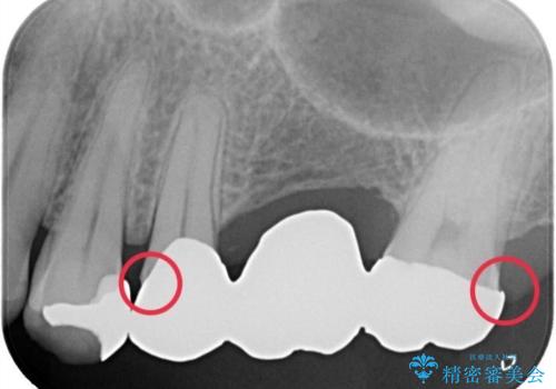 【セラミッククラウン】【ブリッジ】奥歯の奥側からよく汚れが出てくるの治療前