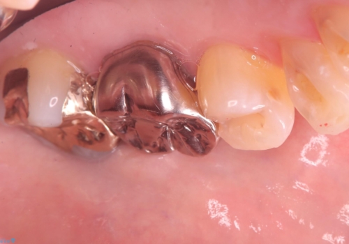フロス通したら詰め物が取れたの治療後