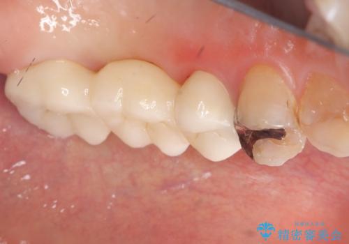 【セラミッククラウン】【ブリッジ】奥歯の奥側からよく汚れが出てくるの治療後