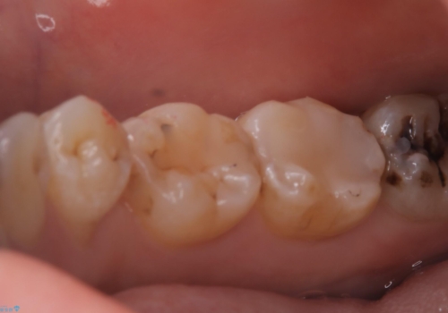 【セラミックインレー】プラスチックの詰め物をセラミックにしたいの治療後