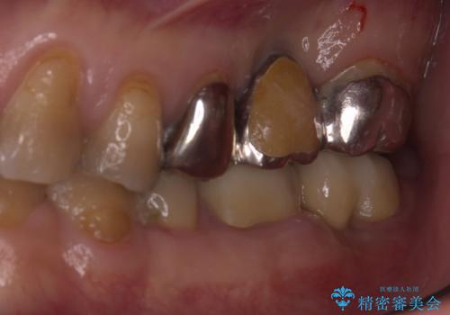 【セラミッククラウン】【ブリッジ】奥歯の奥側からよく汚れが出てくるの治療前