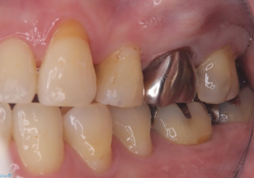 フロス通したら詰め物が取れたの治療前