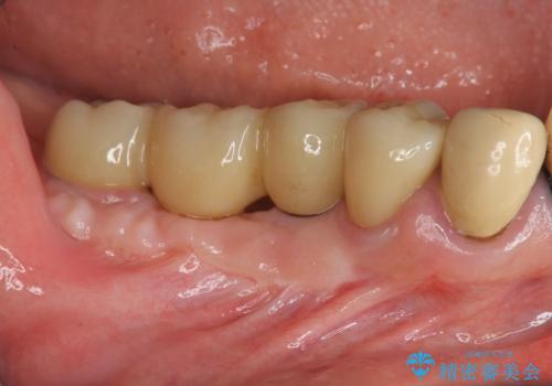 狭小な歯槽骨に対するインプラント治療の症例 治療後