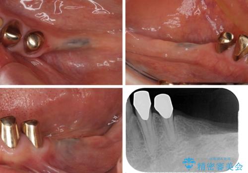 入れ歯を使いたくない　細い骨にインプラントを埋入した補綴治療の治療前
