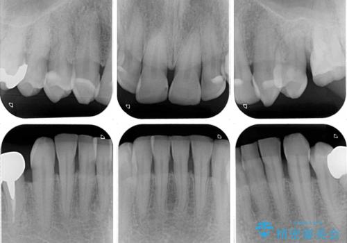 黄ばんだ前歯をきれいに 前歯の審美歯科治療の治療前