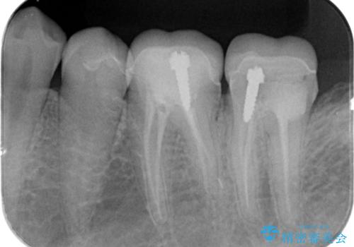 割れたクラウン 再発した虫歯の治療の治療前