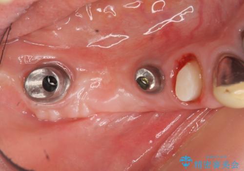 狭小な歯槽骨に対するインプラント治療の治療中