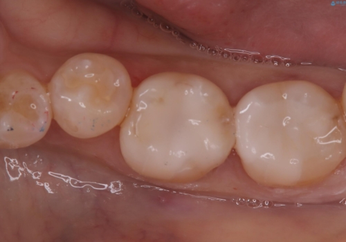 【セラミックインレー】詰め物が外れた 白くしたいの治療後