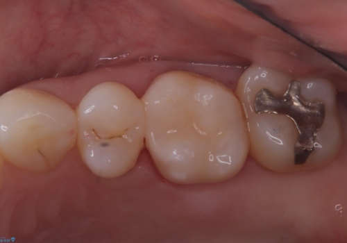 詰め物と歯の境目に汚れが溜まるの症例 治療後