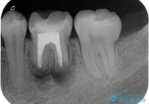 【歯根端切除術】根っこの先端の病気が治らないの治療中