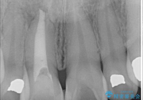 器具が破折して残ったままの前歯の治療後
