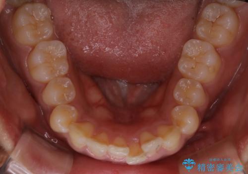 インビザライン矯正 歯を抜かずに出っ歯を改善!の治療前