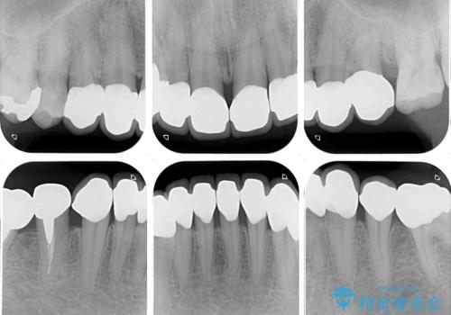 黄ばんだ前歯をきれいに 前歯の審美歯科治療の治療後