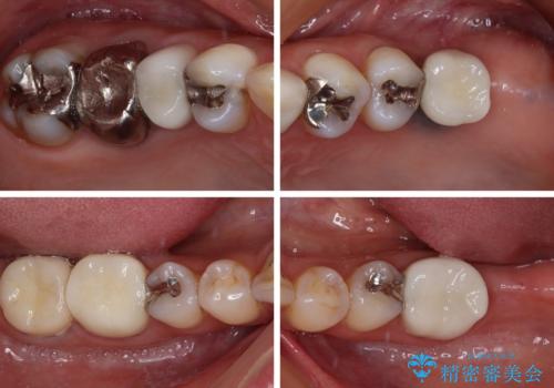 大きなむし歯と欠損をセラミックに　部分矯正を併用した総合歯科治療の治療後