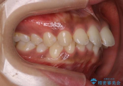 インビザライン矯正　歯を抜かずに出っ歯を改善!の治療前