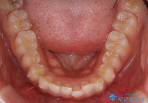 インビザライン矯正 歯を抜かずに出っ歯を改善!の治療中