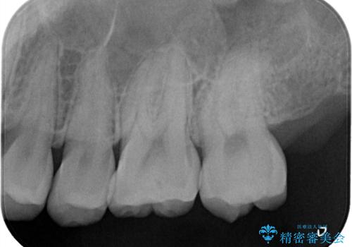 【ハイブリッドインレー】定期検診で見つかった虫歯!の治療前