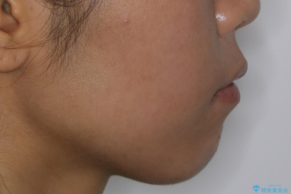 インビザライン矯正 歯を抜かずに出っ歯を改善!の治療後(顔貌)