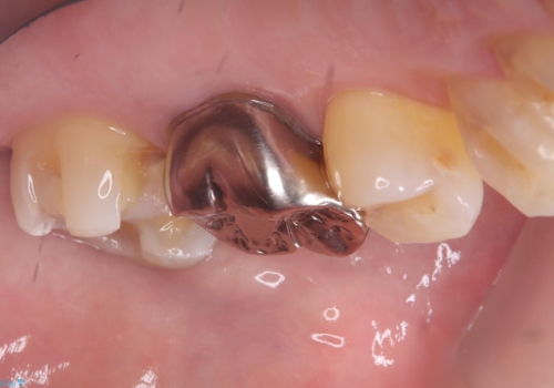 フロス通したら詰め物が取れたの治療中