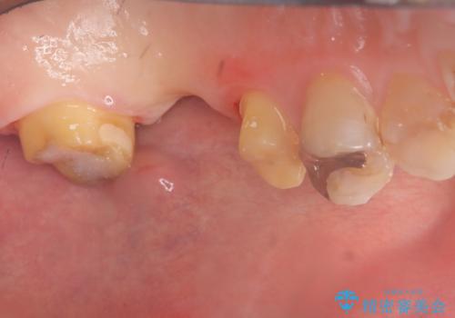 【セラミッククラウン】【ブリッジ】奥歯の奥側からよく汚れが出てくるの治療中