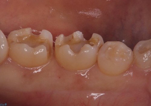 【セラミックインレー】詰め物が外れた 白くしたいの治療中