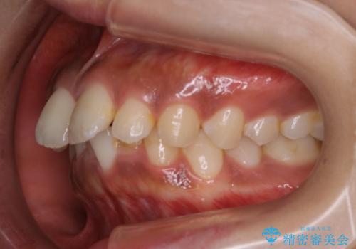 インビザライン矯正　歯を抜かずに出っ歯を改善!の治療前