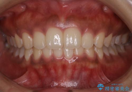 インビザライン矯正　歯を抜かずに出っ歯を改善!の症例 治療後