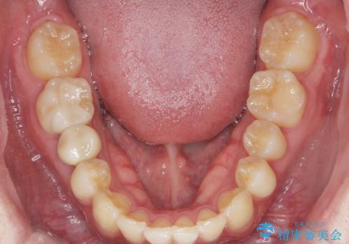 前歯のがたつきをなおしたい マウスピース矯正の治療後