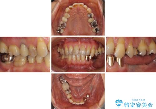 入れ歯を使いたくない 細い骨にインプラントを埋入した補綴治療の治療前