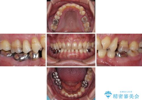 黄ばんだ前歯をきれいに 前歯の審美歯科治療の治療前