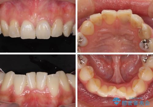 大きなむし歯と欠損をセラミックに 部分矯正を併用した総合歯科治療の治療前