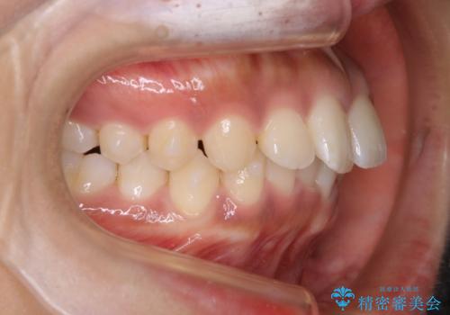 インビザライン矯正　歯を抜かずに出っ歯を改善!の治療中