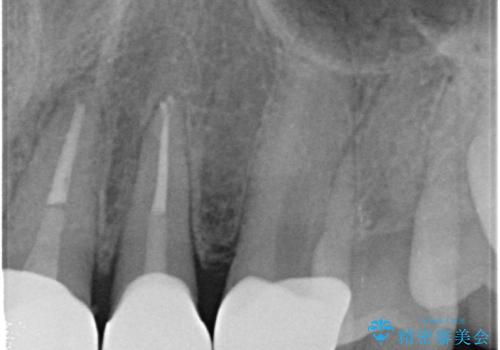 転んで前歯が欠けてぐらぐらに 歯の神経も死んでしまったの治療後