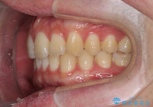 前歯のがたつきをなおしたい マウスピース矯正の治療後